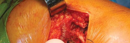 Illustration 56 for Kinectiv® Stem: Modular Necks for Primary THA Success