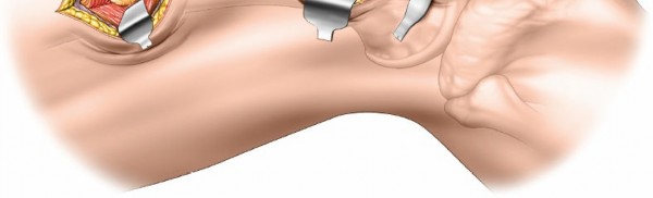Illustration 56 for Optimal Femoral Approaches: Mastering the Lateral Intermuscular Septum