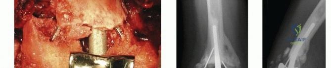 Principles of Hand Fracture Fixation: A Comprehensive Surgical Guide