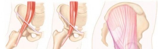 Illustration 21 for Stop the Snap: Hip Preservation for Snapping Iliopsoas Tendon