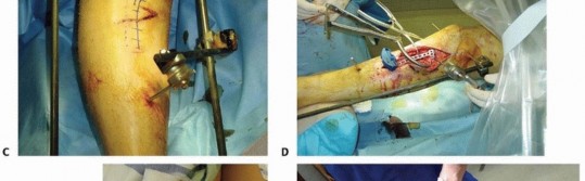 Illustration 51 for Tibia External Fixation: See How Pins Are Placed for Healing