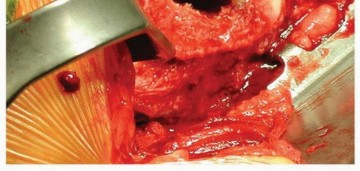 Illustration 9 for Why Polished Tapered Cemented Stems Excel in Hip Replacement