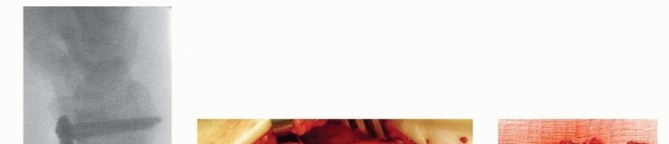 Illustration 23 for Precision Correction for Distal Radius Malunion