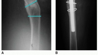 Illustration 16 for Overcoming Proximal Femoral Deformity in THA: Key Strategies