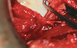 Illustration 66 for Bernese PAO: Unlocking the Procedure with Level V Evidence Insights