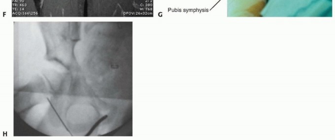 Illustration 8 for Septic Hip in Children: Mastering Anterior Drainage for Optimal Recovery