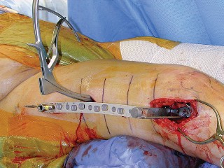 Illustration 15 for Mastering Periprosthetic Femoral Fractures Above Knee Arthroplasty