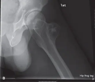 الساركوما الغضروفية: دليل شامل لتشخيص وعلاج أورام العظام مع الأستاذ الدكتور محمد هطيف