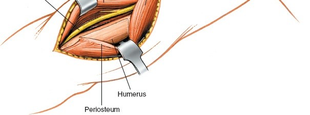 Illustration 66 for Mastering the Approach to the Distal Humerus: Safety & Skills