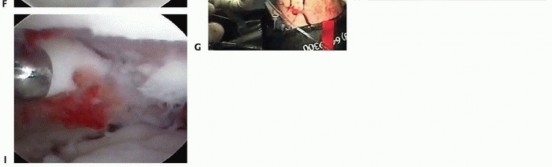 Illustration 16 for Arthroscopic Fixation: Effectively Treating Radial Styloid Fragments