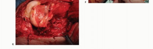 Illustration 41 for Mastering Femoral Metastases: Optimal Function for Femoris & Vastus