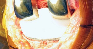 Illustration 16 for Monoblock Total Knee: When to Use & What to Avoid