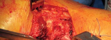 Illustration 32 for Kinectiv® Stem: Modular Necks for Primary THA Success