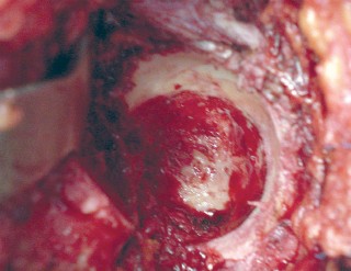 Illustration 31 for Mastering the Cementless Acetabular Cup: Techniques for Optimal Fixation
