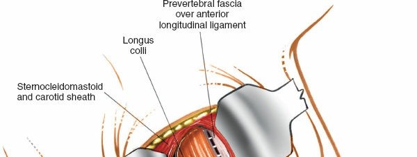 Illustration 16 for Mastering the Anterior Cervical Approach: Longus Colli Muscle Insights