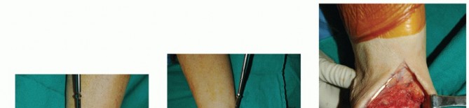 Illustration 20 for Optimize Pain Management with Proximal Ring Block for Ankle Arthrodesis