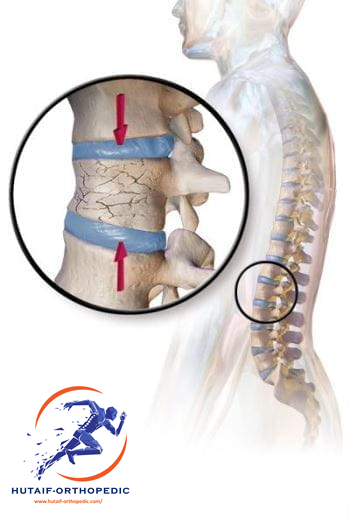 هشاشة العظام وكسور الفقرات: الأسباب، الأعراض، والعلاج