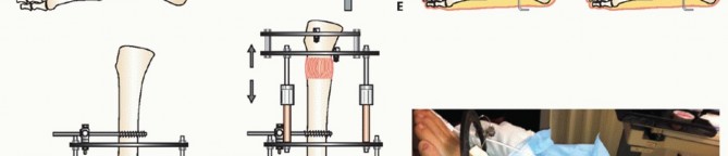 Illustration 12 for Beyond Amputation: Circular Fixation for Infection of the Talus