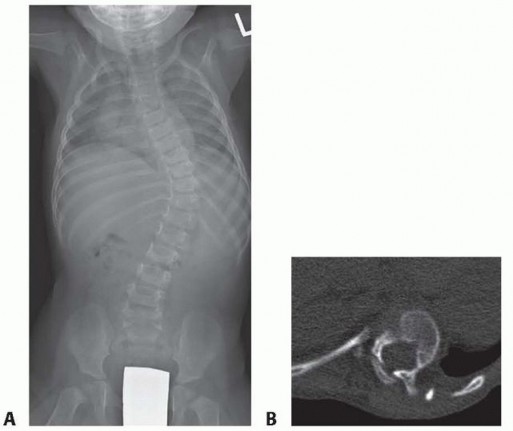 Illustration of scoliosis j bone - Dr. Mohammed Hutaif