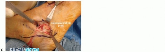 Illustration 10 for Lateral Column Lengthening: Relieve Flatfoot Pain & Correct Deformity