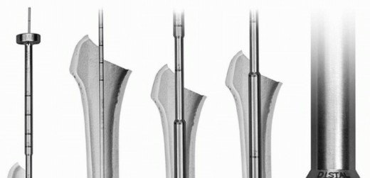 Illustration 21 for Cement in Cement Revision: Simplifying Complex Hip Revisions