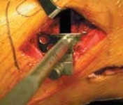 Illustration 37 for Guide Pin Assembly: Key to Flawless Upper Tibial Osteotomy