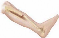 Illustration 14 for Solving Congenital Pseudarthrosis: Tibia with the Williams Rod