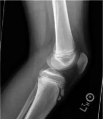 الكسور المعقدة في صفيحة النمو الظنبوبية لدى الأطفال والمراهقين: دليل شامل من الأستاذ الدكتور محمد هطيف