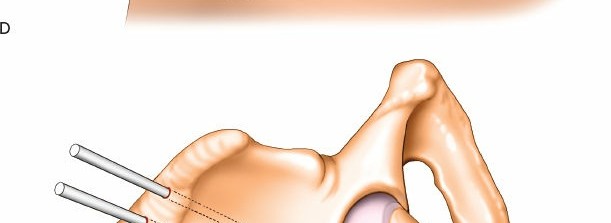 Illustration 20 for Expert Guide: Ulna and Wrist External Fixation Pin Placement