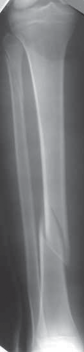 Illustration 7 for Optimal Nailing of the Tibia: Techniques for Challenging Fractures