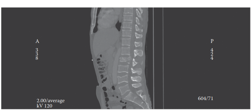 When to Operate? Understanding Thoracolumbar Spine Injury