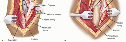 Illustration 61 for Surgical Approaches to Shoulder & Elbow: Pearls and Pitfalls