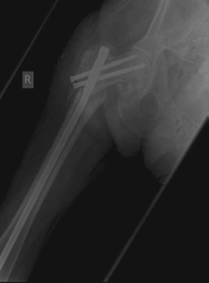 Illustration 4 for Lower Limb Trauma: Decipher Anteroposterior (AP) Figure for Exams