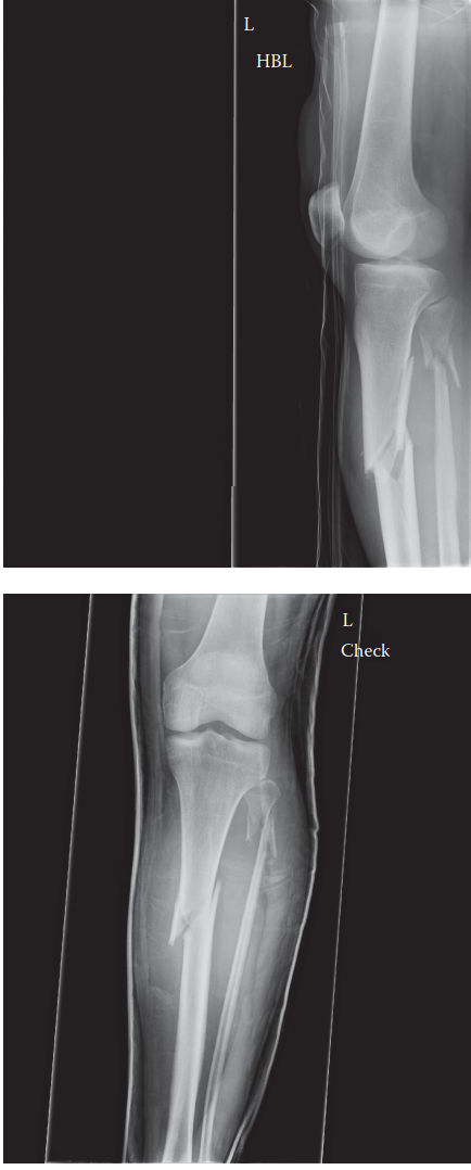 Trauma Case 60 TIBIAL DIAPHYSEAL FRACTURE (PROXIMAL)