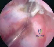 Illustration of distal clavicle resection - Dr. Mohammed Hutaif