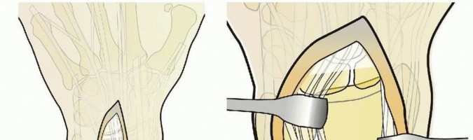 Illustration 16 for Fragment-Specific Fixation: Restore Carpal Facet Horizon