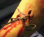 Illustration 35 for Optimal Nailing of the Tibia: Techniques for Challenging Fractures