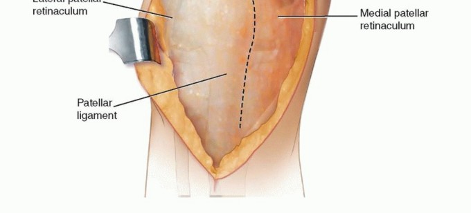 Illustration 13 for Correcting Stiffness in Revision TKA: Achieve Appropriate External Rotation