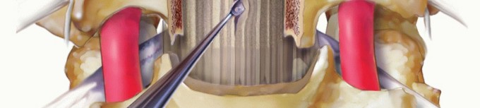 Illustration 14 for Stop Numbness & Instability: Corpectomy and Fusion Guide