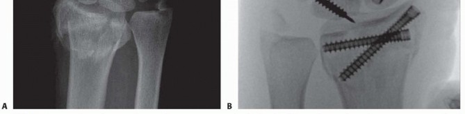 Illustration 19 for Arthroscopic Fixation: Effectively Treating Radial Styloid Fragments