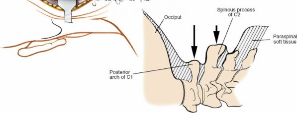 Illustration 227 for Approach to the Lumbar Spine: Mastering Techniques & Anatomy