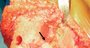 Illustration 12 for Precision Soft Tissue Balancing in Revision: Avoid TKA Pitfalls