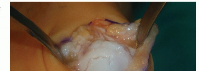 Illustration 13 for Mastering Extensive Plantar Release for Hallux Rigidus