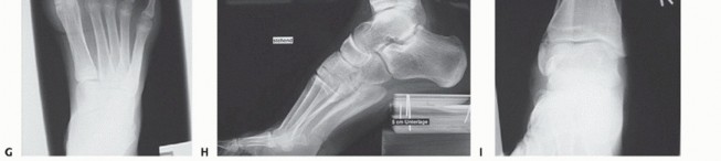Illustration 51 for How Achilles Tendon Lengthening Fixes Equinocavovarus Foot