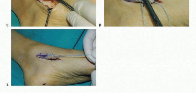 Illustration 7 for Foot Drop Surgery: How a Pin or Drill Elevates Tendon Transfer
