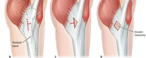 Illustration 134 for Stop the Snap: Hip Preservation for Snapping Iliopsoas Tendon
