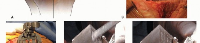 Illustration 25 for Achieve Lasting Pain Relief with Cemented Total Knee Arthroplasty