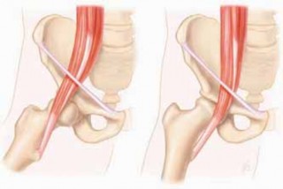 Illustration 4 for J. W. Thomas on Snapping Hip: Causes, Cures & Relief