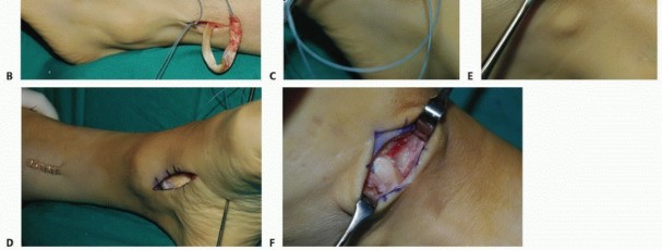 Illustration 17 for Foot Drop Surgery: How a Pin or Drill Elevates Tendon Transfer