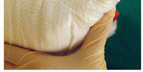 Illustration 12 for Mastering Extensive Plantar Release for Hallux Rigidus